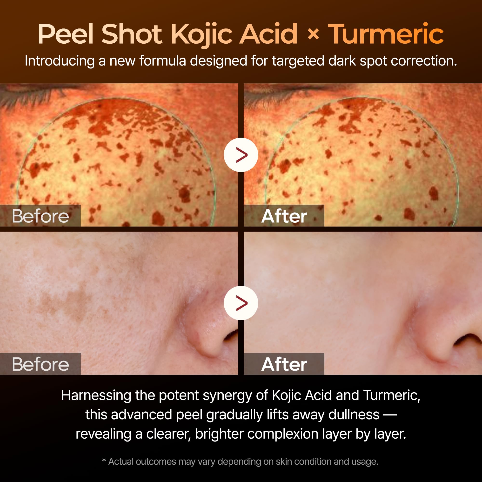 Dr. Melaxin Peel Shot Kojic Acid Turmeric Serum – Exfoliating Dark Spot Corrector with AHA/BHA & Niacinamide, Brightening & Even Tone Facial Serum (80ml / 2.70 fl oz)